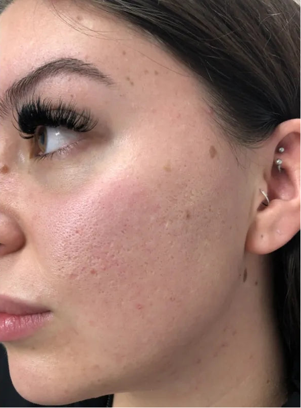 Before and after comparison of a woman's face with visible acne on the left, and clearer skin on the right.