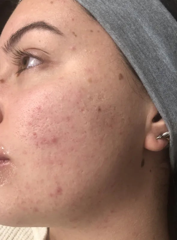 Before and after comparison of a woman's face with visible acne on the left, and clearer skin on the right.