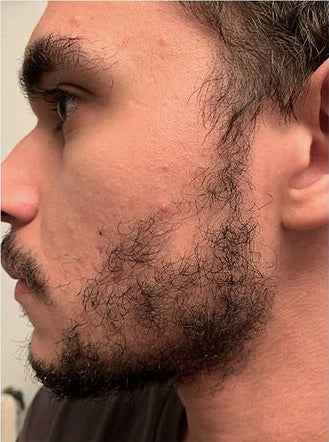 Before and after comparison of a beard growth journey with 'beardjourney' hashtag.