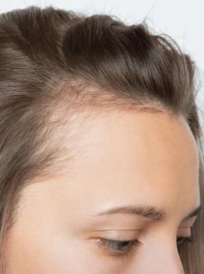Side-by-side comparison of a woman's hairline before and after a hair transplant procedure.