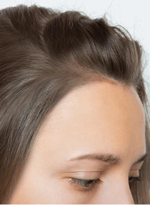 Side-by-side comparison of a woman's hairline before and after a hair transplant procedure.
